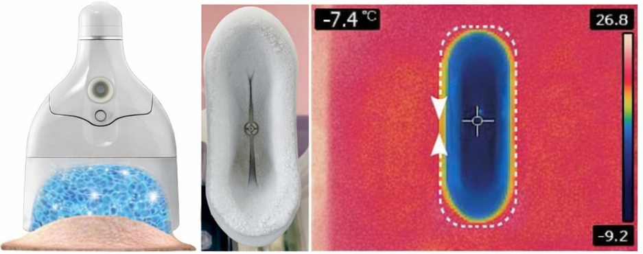 Diamond ICE 360: thermal image showing even all-around cooling across the applicator footprint